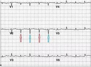 心电图教学视频,掌握心脏健康监测的关键技巧
