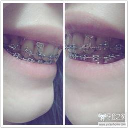 取牙套视频,跟随视频一起见证牙齿蜕变之旅